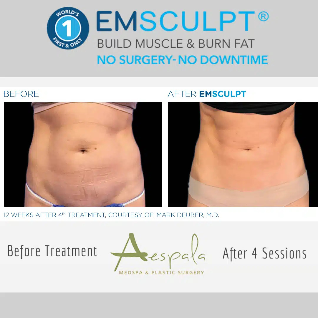 Emsculpt Before & After Image