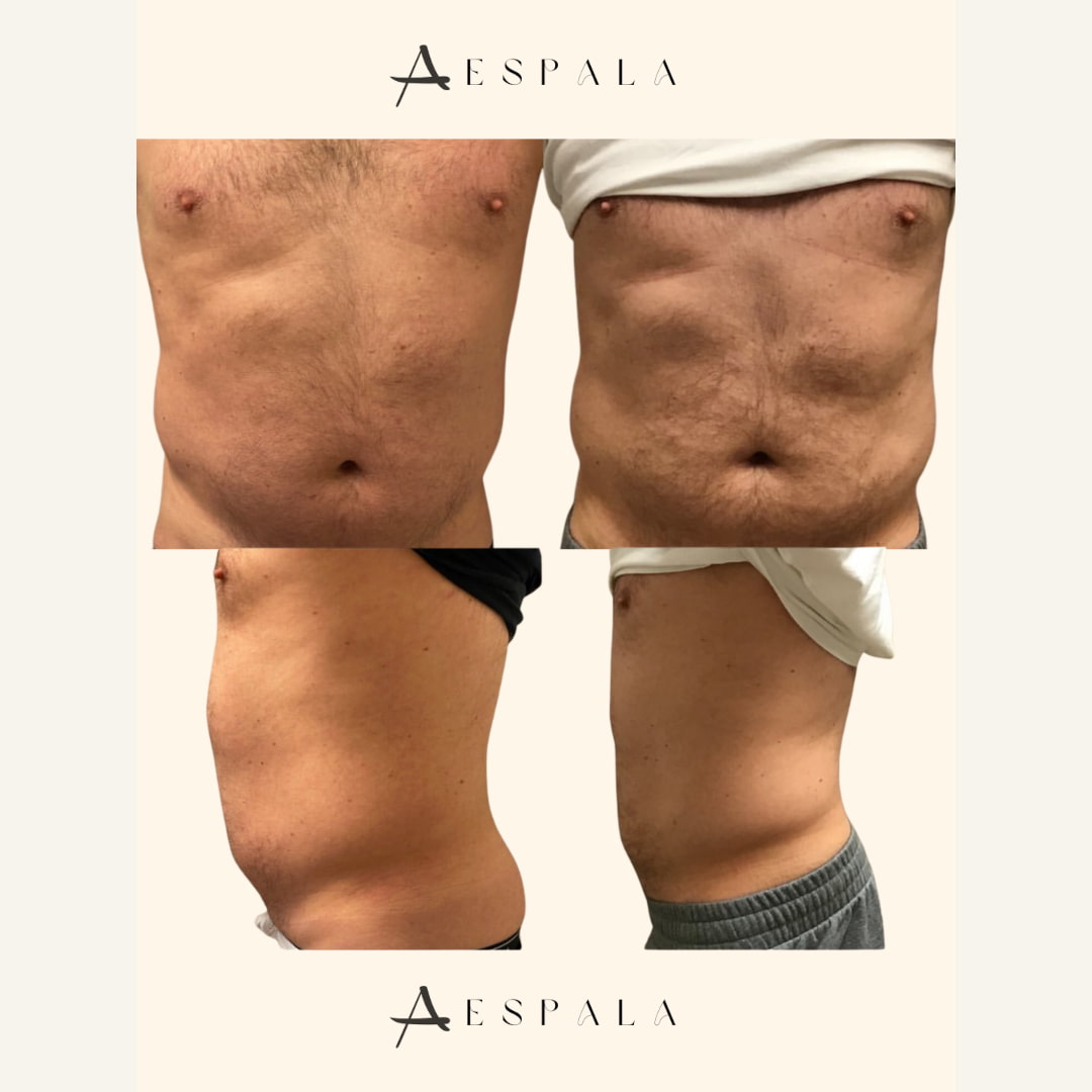 Emsculpt Before & After Image