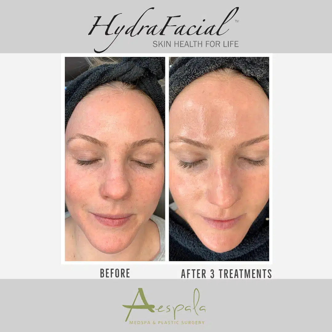 Facials Before & After Image