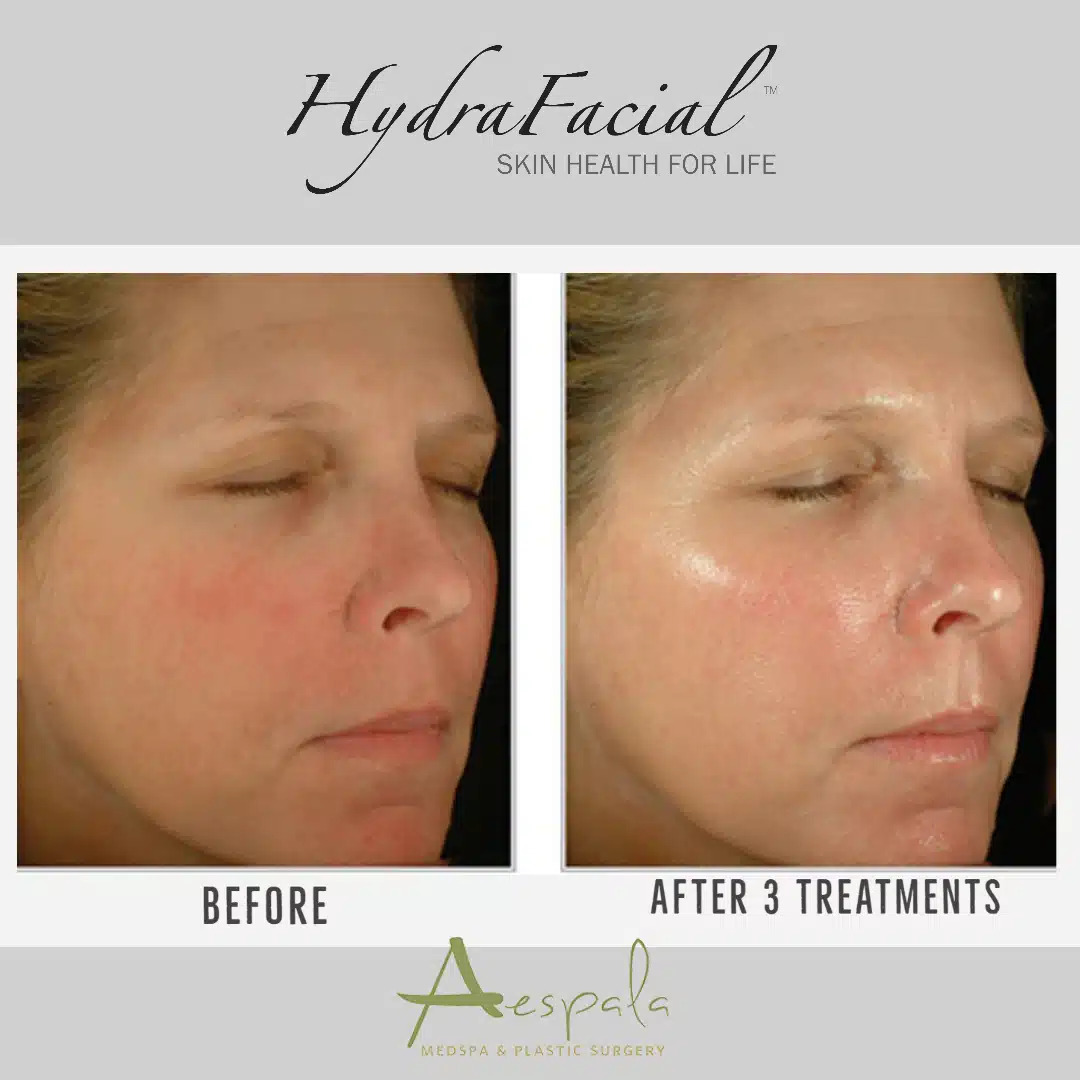 Facials Before & After Image