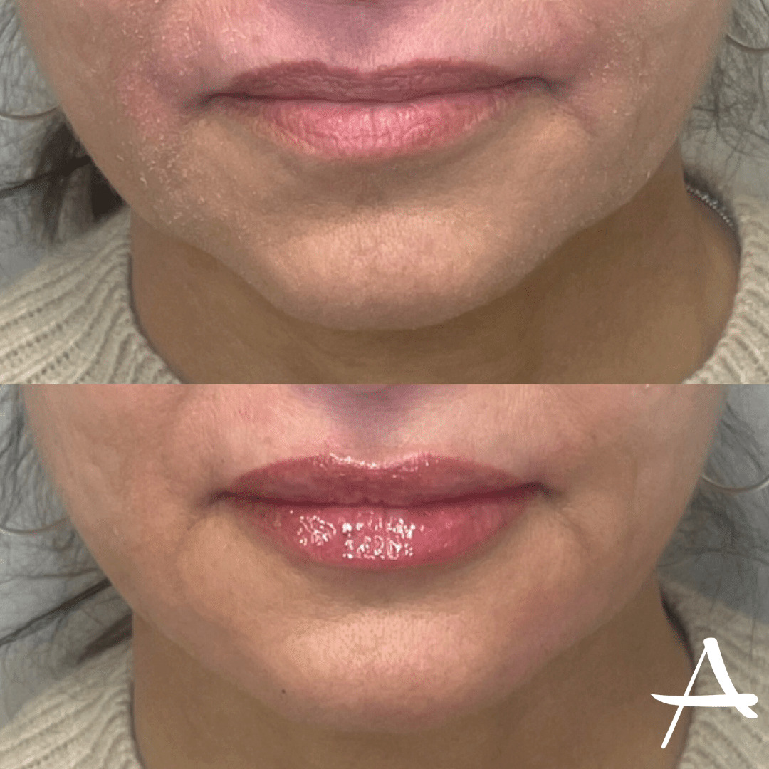 Injections Before & After Image