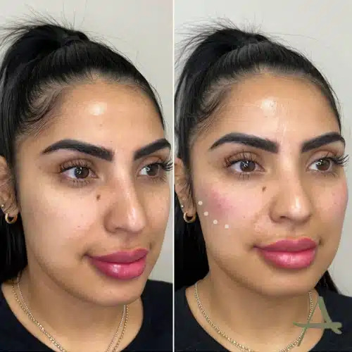 Injections Before & After Image