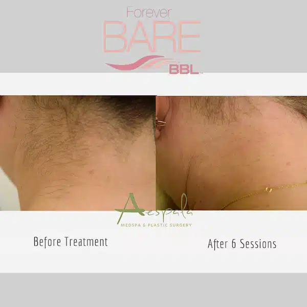 Laser Hair Removal Before & After Image