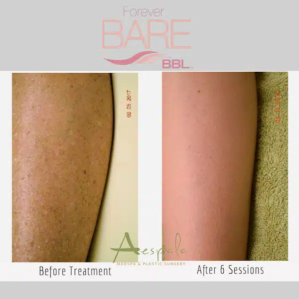 Laser Hair Removal Before & After Image