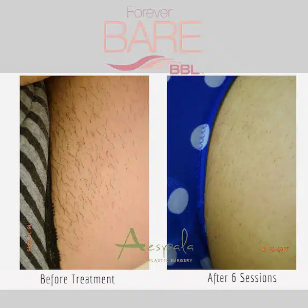 Laser Hair Removal Before & After Image