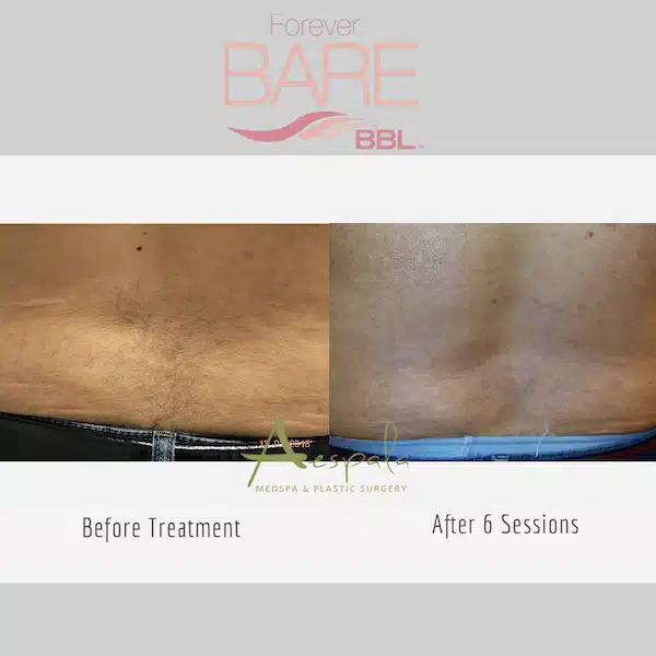 Laser Hair Removal Before & After Image