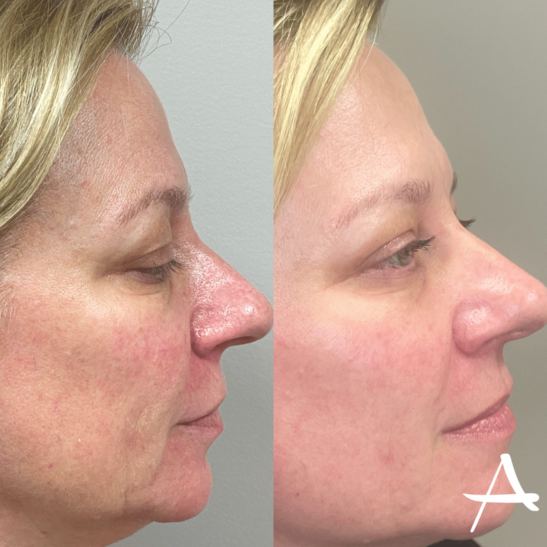 Microlaser Peel Before & After Image