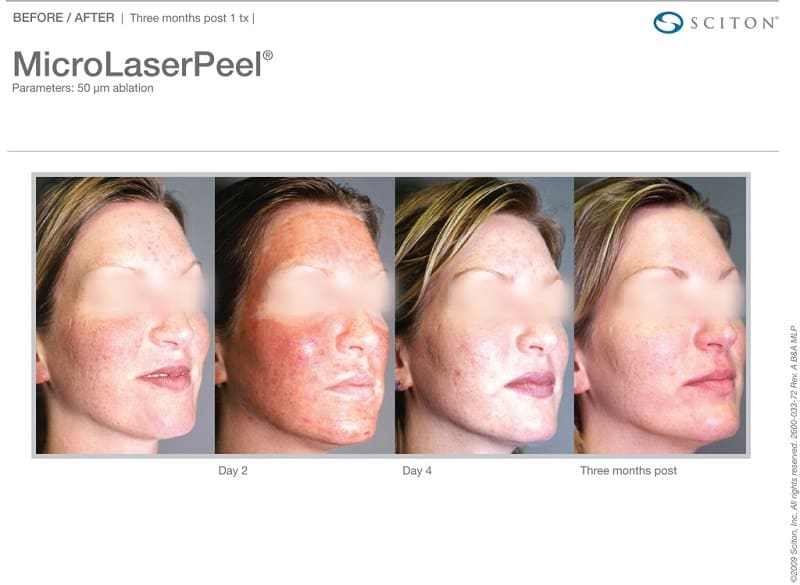 Microlaser Peel Before & After Image