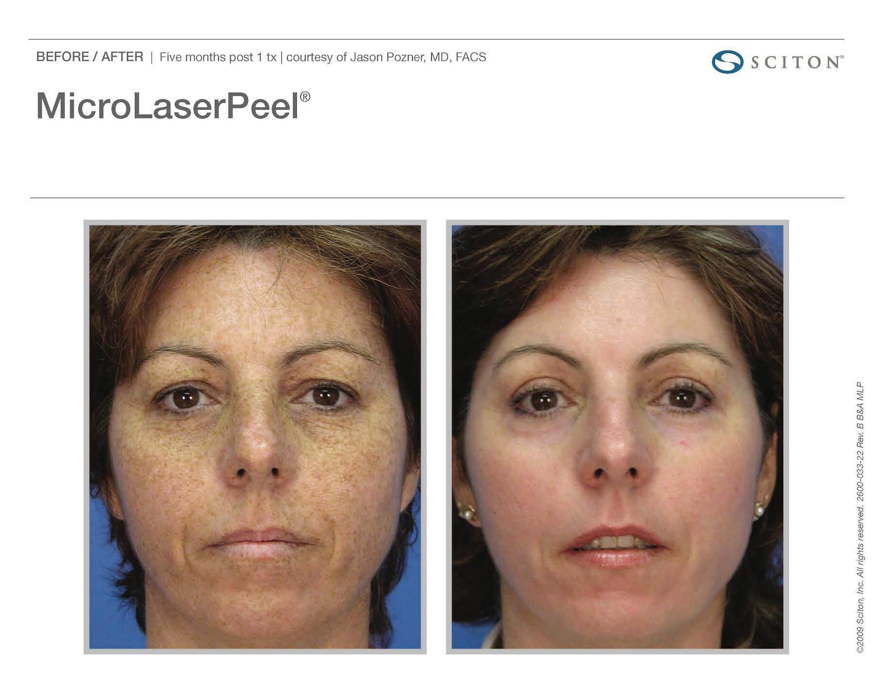 Microlaser Peel Before & After Image