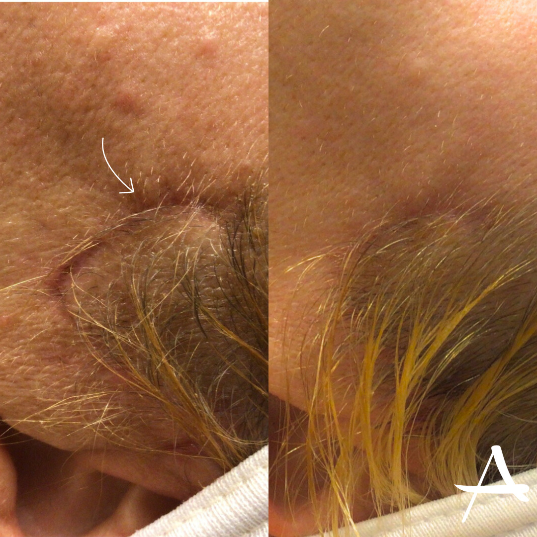 Microneedling Before & After Image