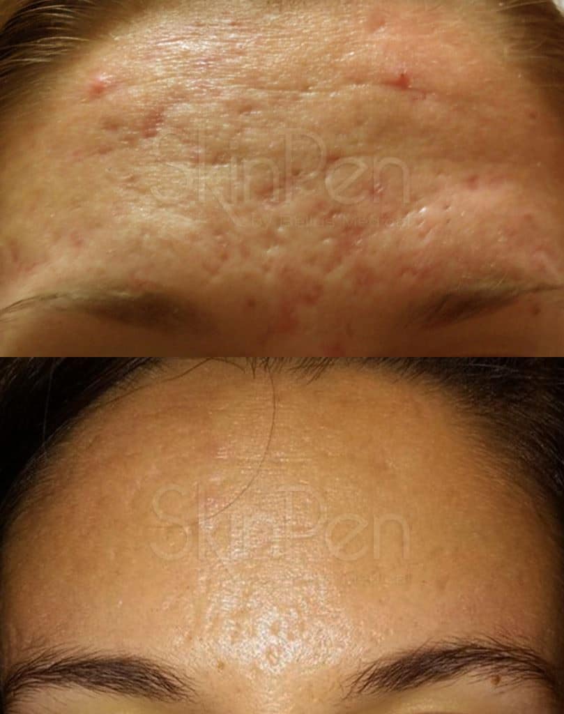 Microneedling Before & After Image