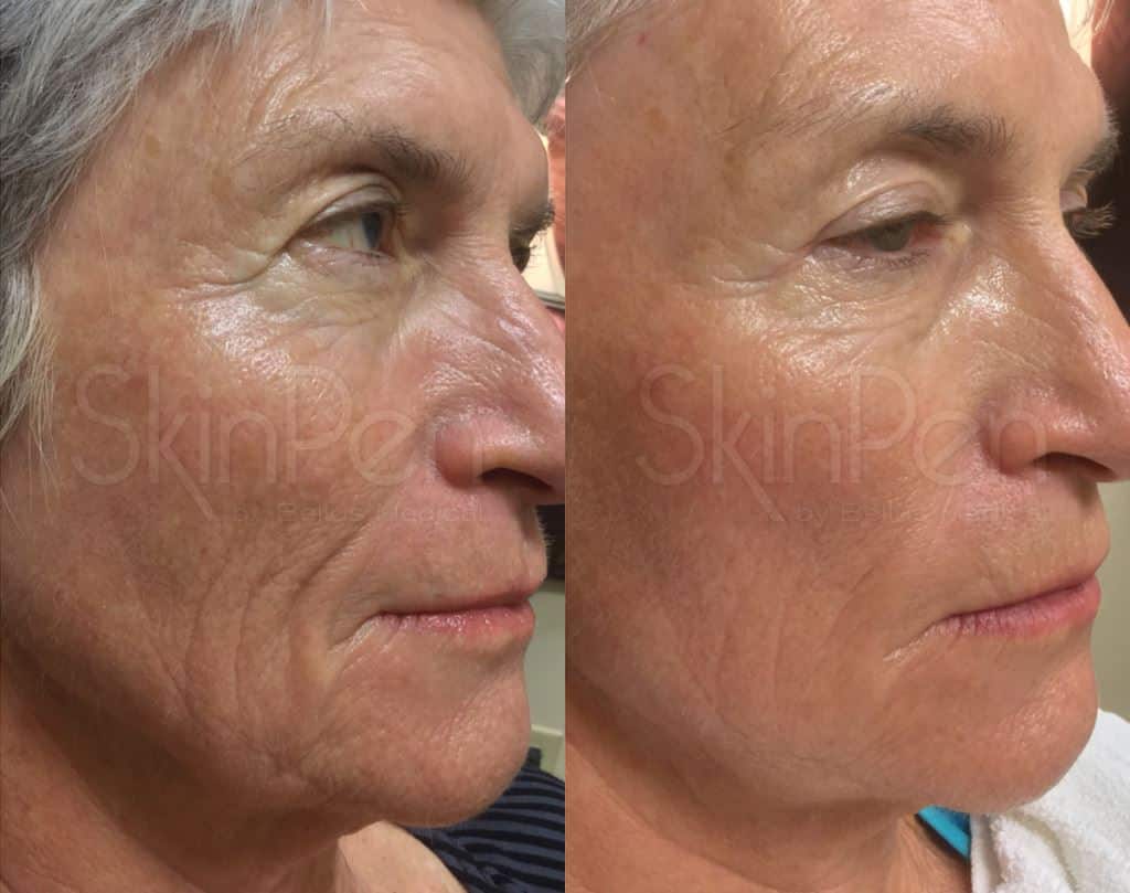 Microneedling Before & After Image