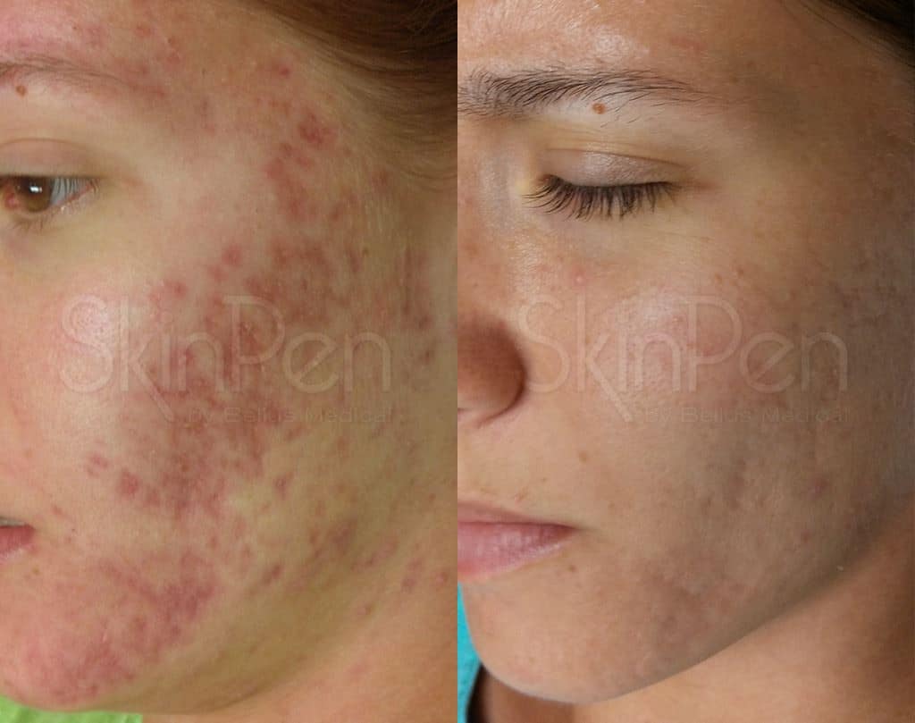 Microneedling Before & After Image