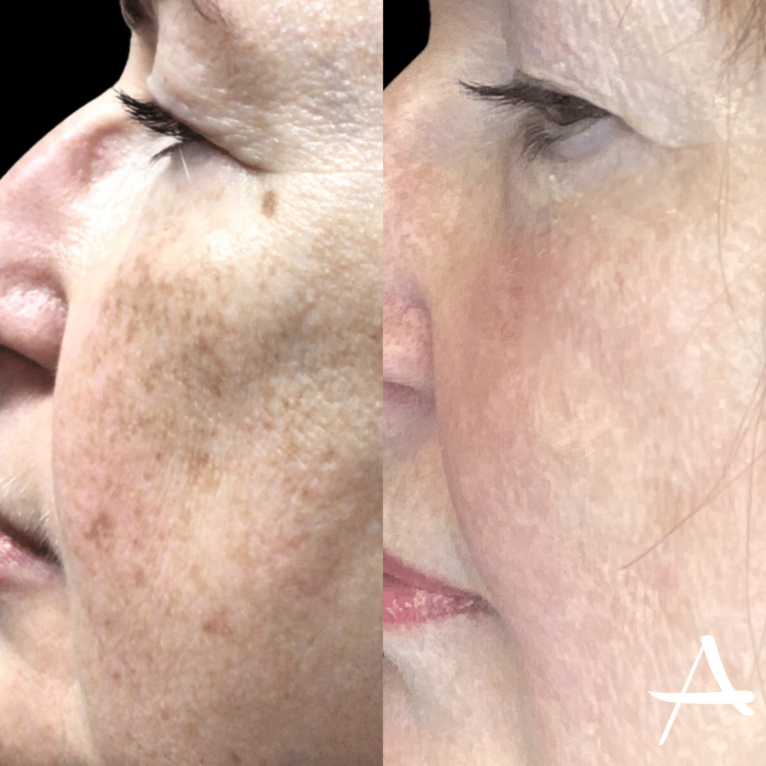 Microneedling Before & After Image