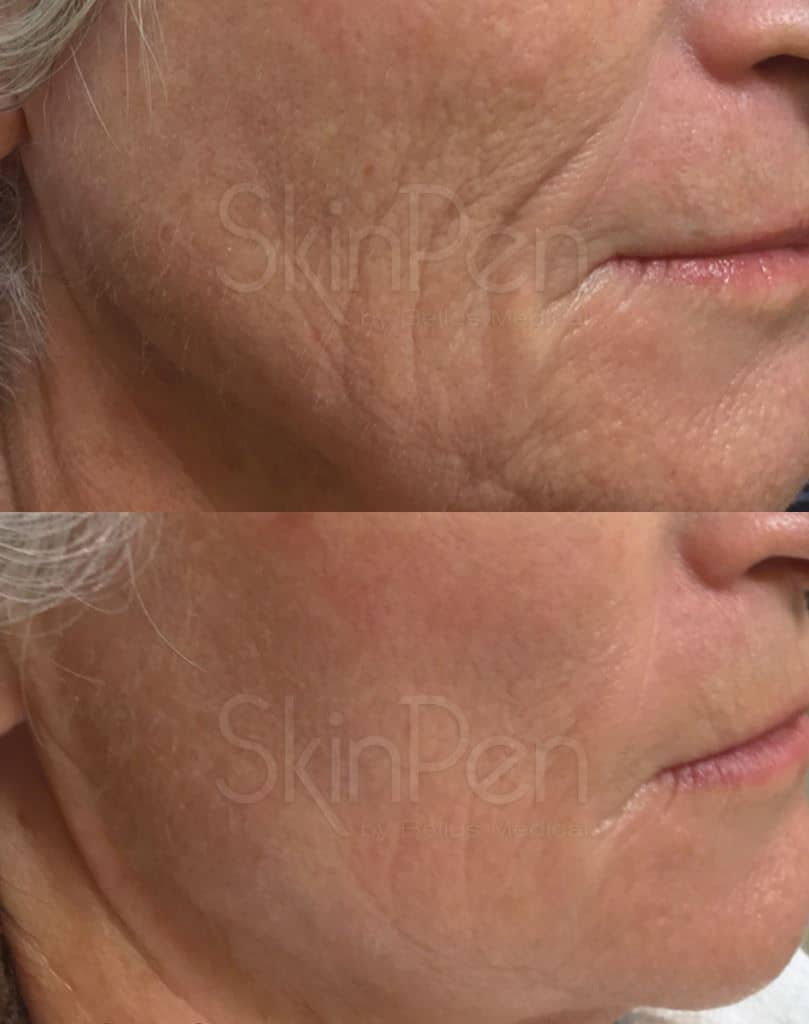 Microneedling Before & After Image