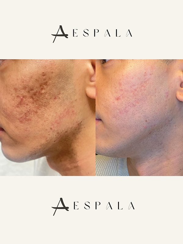 ProFractional Laser Before & After Image