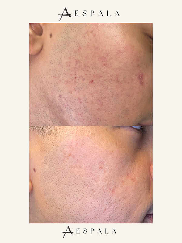 ProFractional Laser Before & After Image