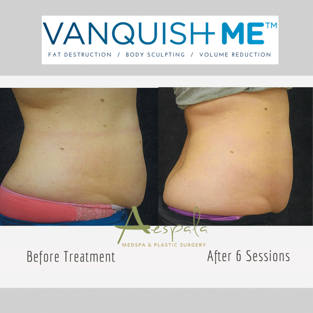 Vanquish ME Before & After Image