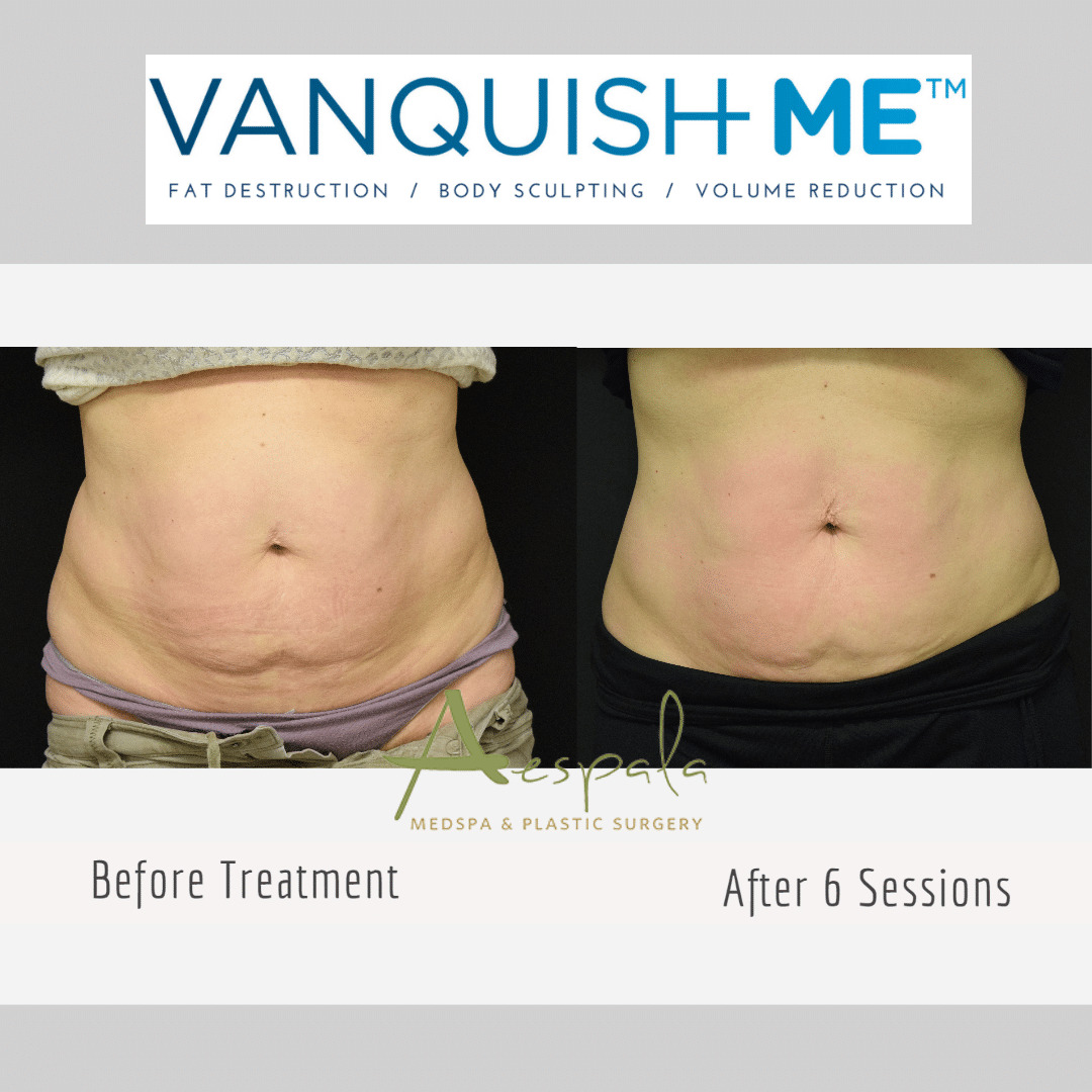 Vanquish ME Before & After Image