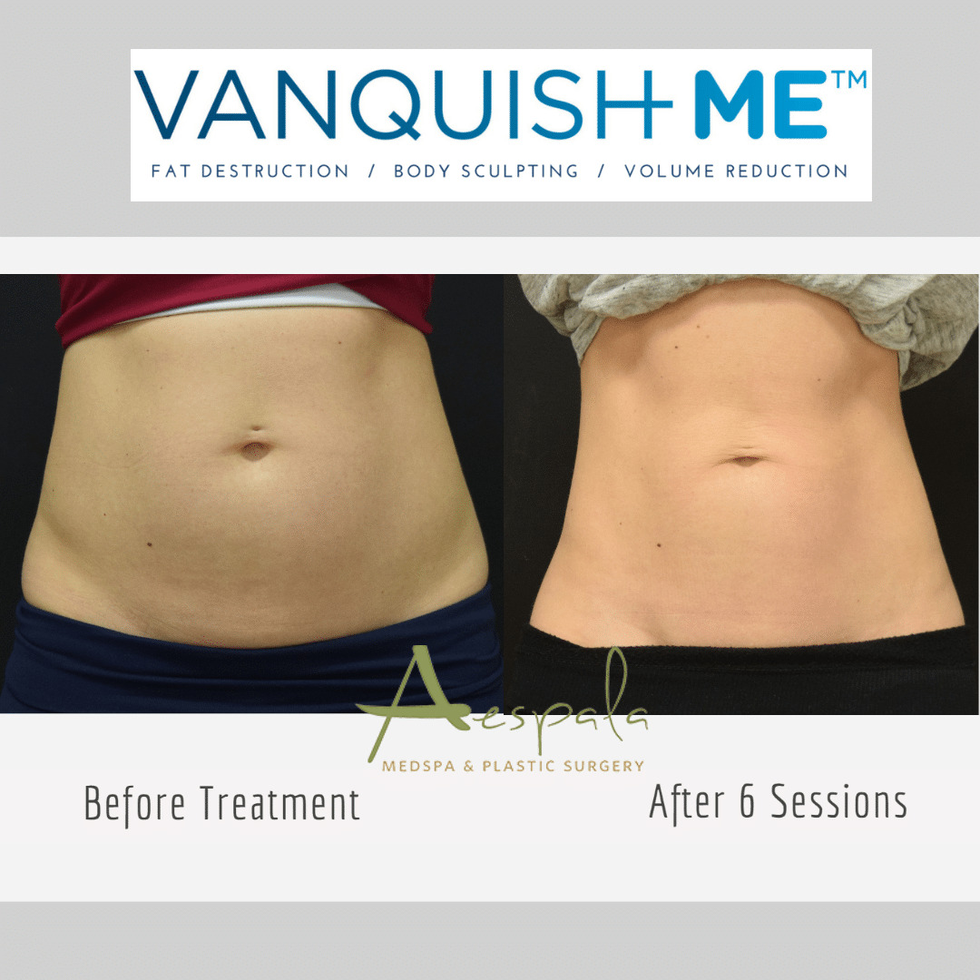 Vanquish ME Before & After Image