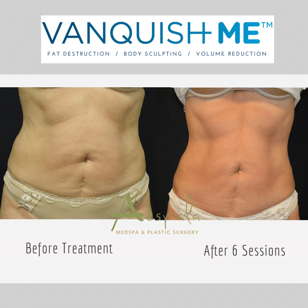 Vanquish ME Before & After Image