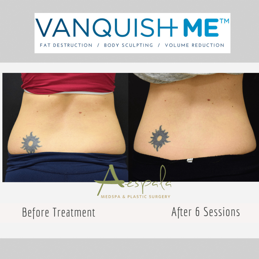 Vanquish ME Before & After Image