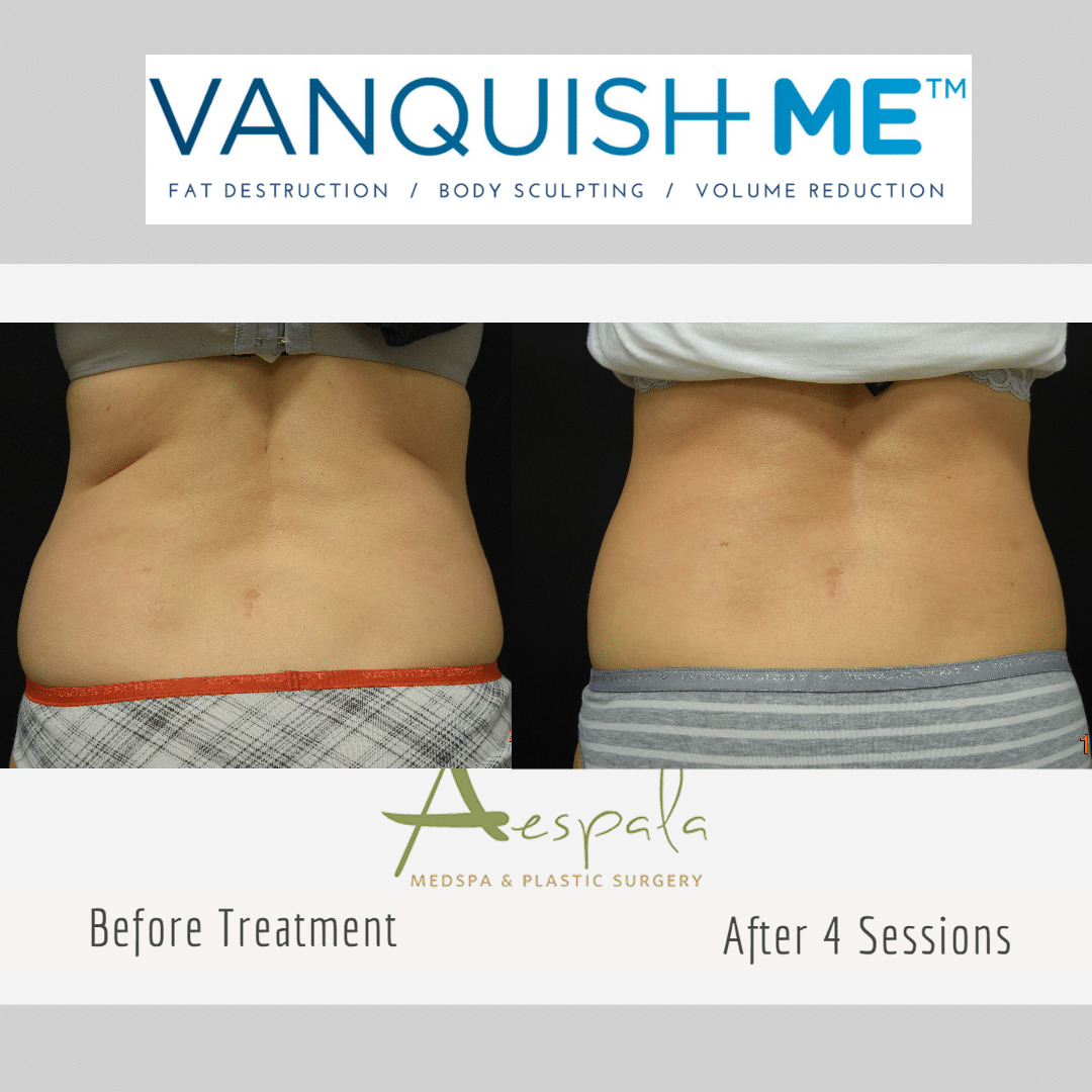 Vanquish ME Before & After Image