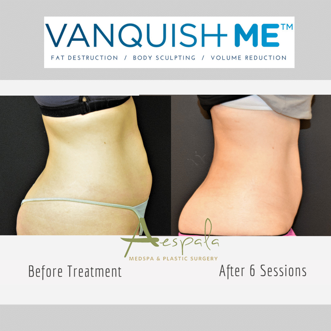 Vanquish ME Before & After Image