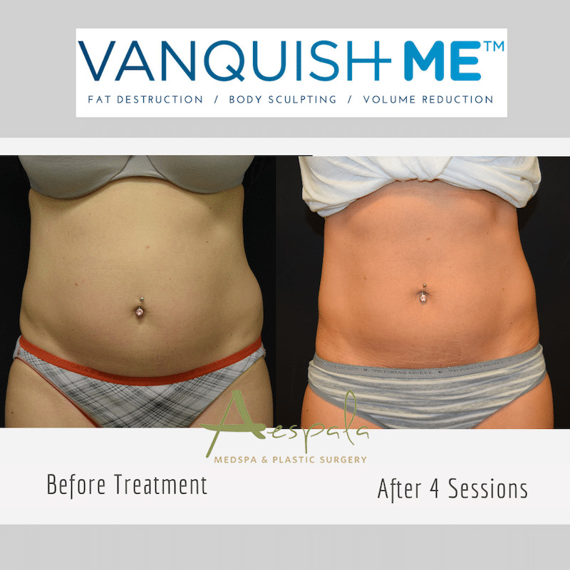 Vanquish ME Before & After Image