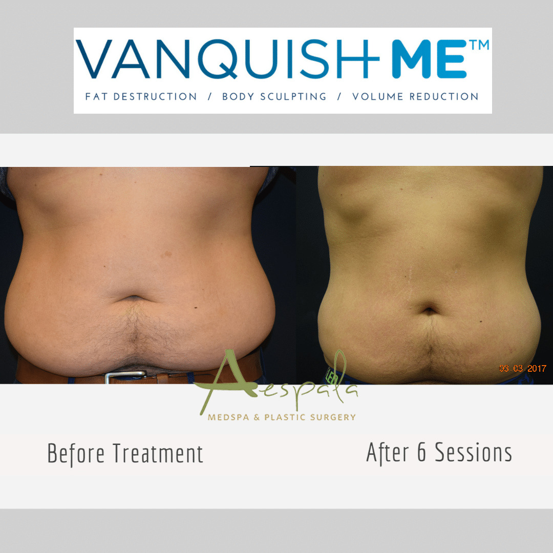 Vanquish ME Before & After Image