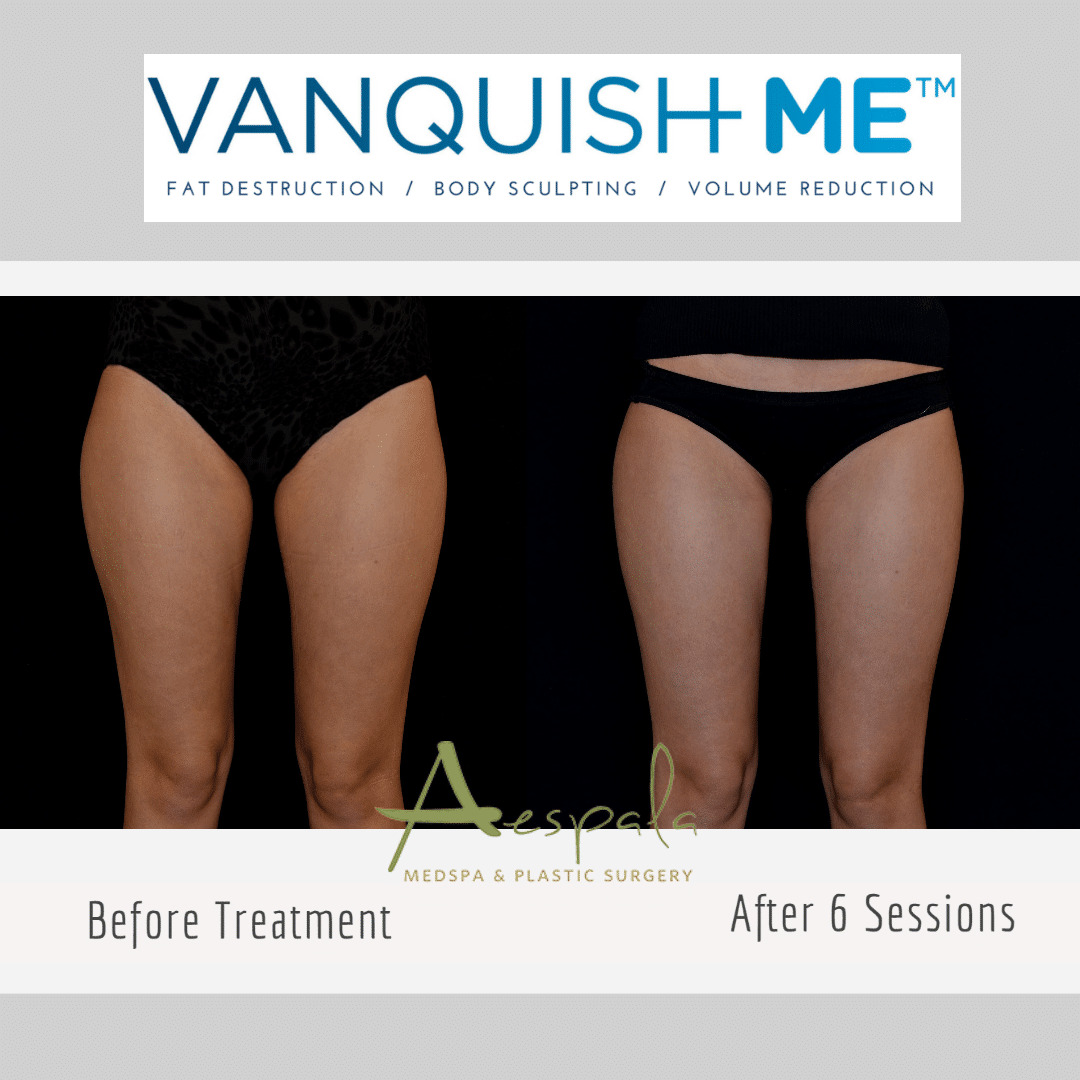 Vanquish ME Before & After Image