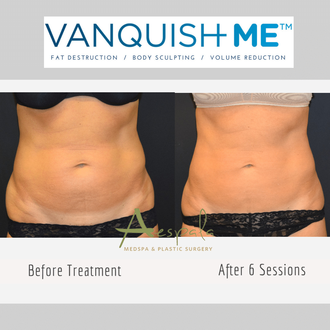 Vanquish ME Before & After Image