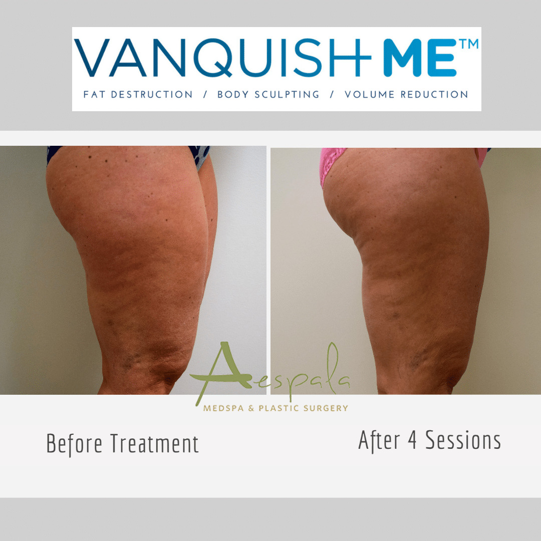 Vanquish ME Before & After Image