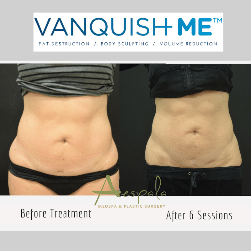 Vanquish ME Before & After Image