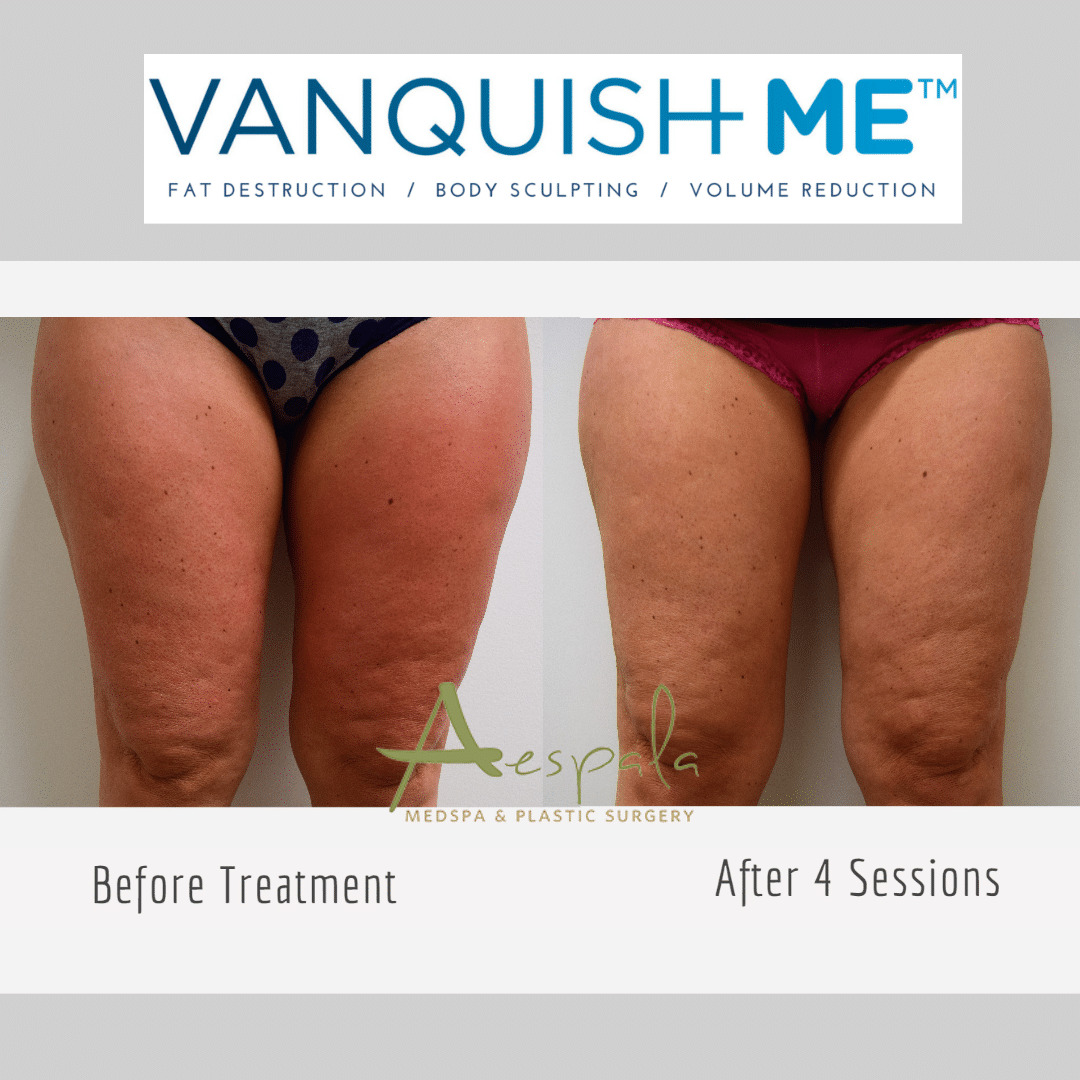 Vanquish ME Before & After Image